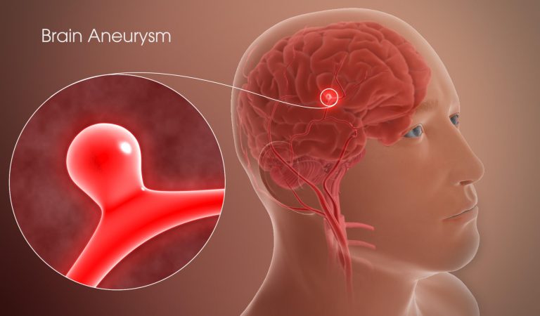 Aneurysm: Signs and Symptoms You Shouldn’t Ignore Aneurysm: Signs and Symptoms You Shouldn’t Ignore